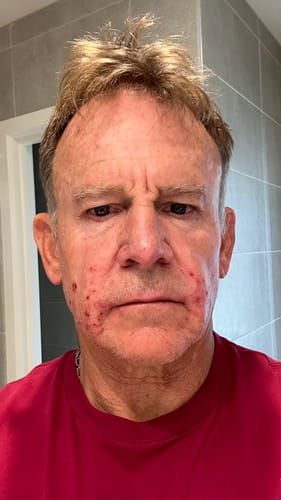 Customer photo review of Advanced Acne Program™
