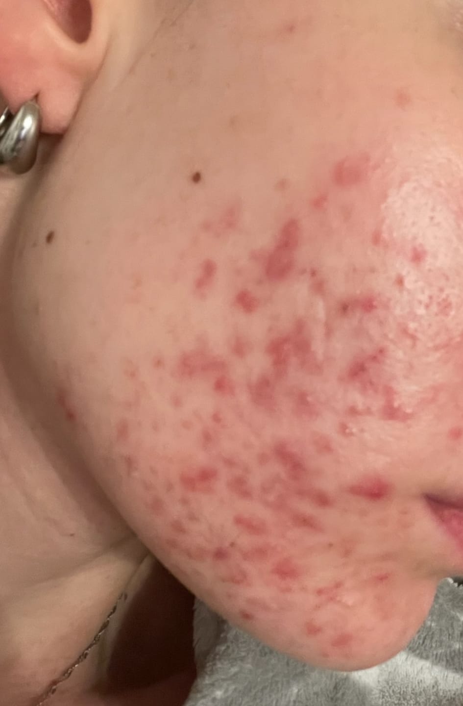 Customer photo review of Madecassoside Cream 2X