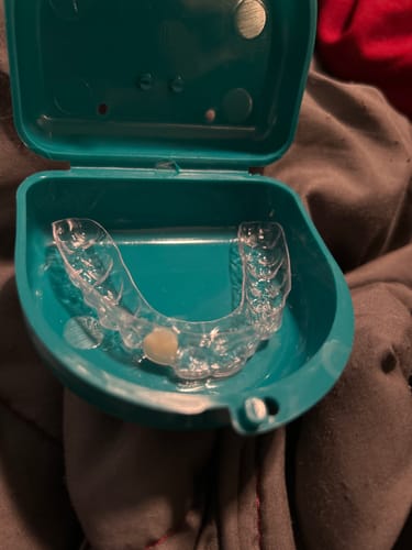 Customer photo review of Upper Partial Denture Retainer (1 Tooth Only)