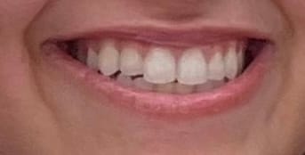 Customer photo review of Teeth Whitening Strips