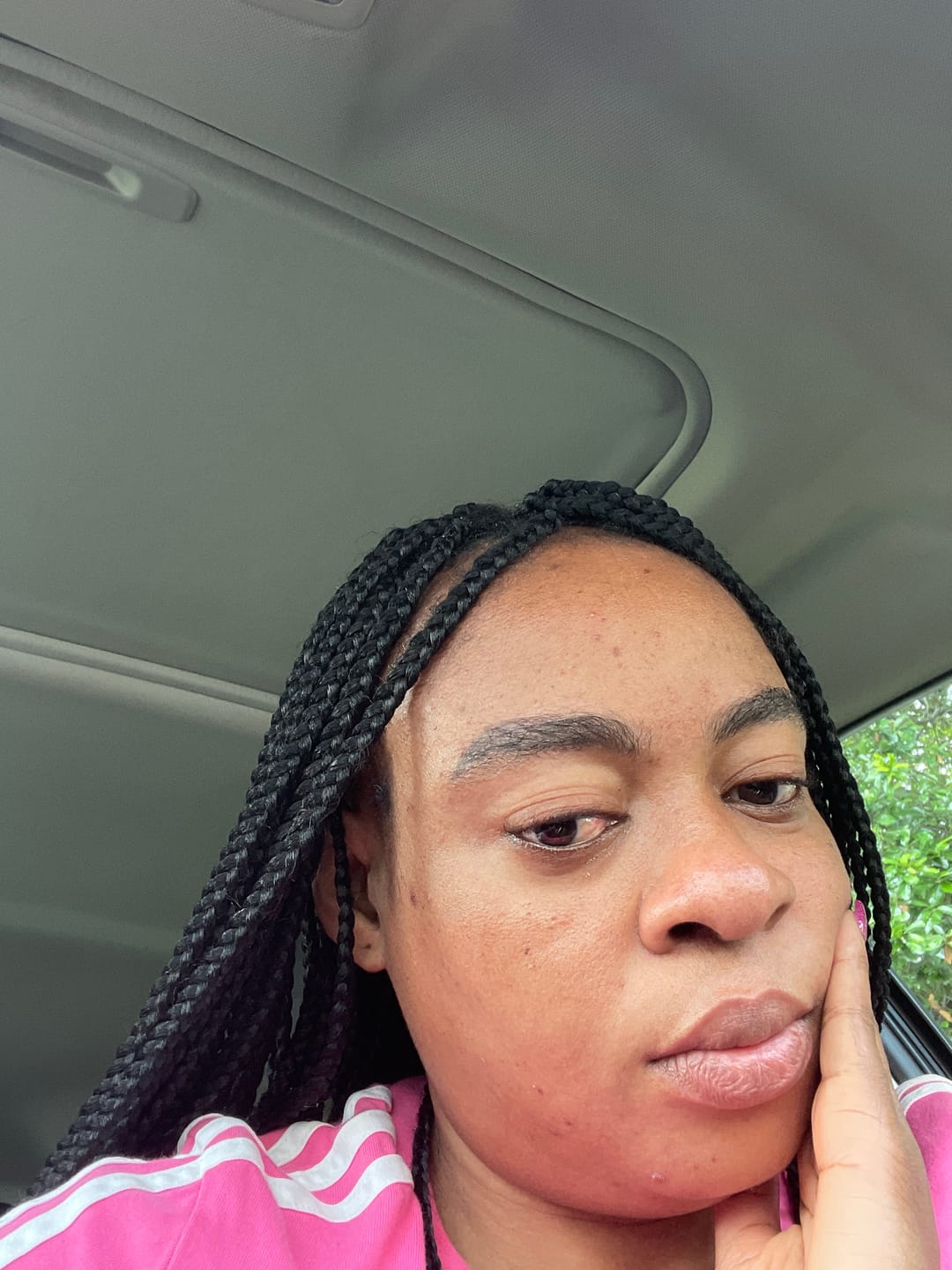Customer photo review of Neoprosone Brightening Cream - Dark Spot Remover - 50ml / 1.7 fl oz