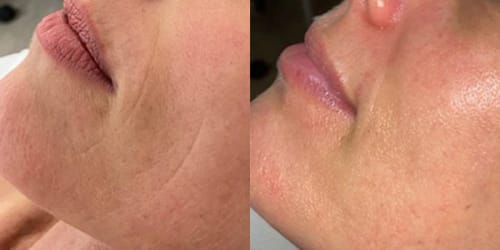 Customer photo review of Skin Fit Topical Filler Ampoules