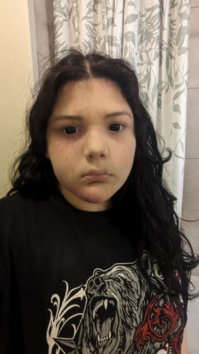 Customer photo review of Linn's Sullen Doll Eye 17mm Mini Sclera Contact Lenses(12 months of use)