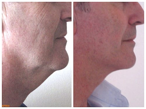 Customer photo review of Appareil EMS - Rajeunissement Facial et du Cou