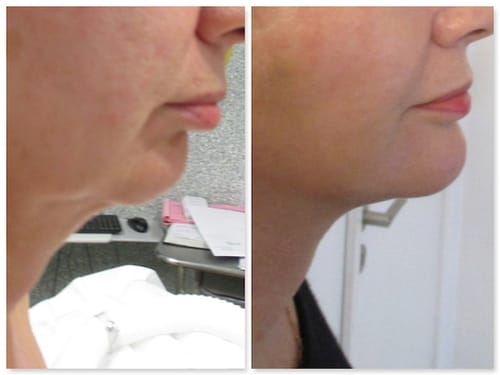 Customer photo review of Appareil EMS - Rajeunissement Facial et du Cou