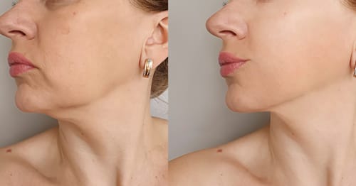 Customer photo review of Appareil EMS - Rajeunissement Facial et du Cou