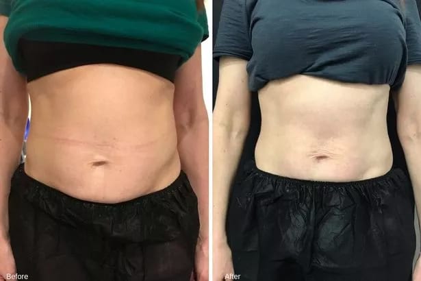 Customer photo review of EMSlim Neo Machine Portable Pro