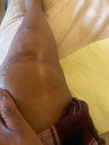 Customer photo review of Therapeutic Shea Butter - Fast Penetrating Relief of Sore Muscles & Joints