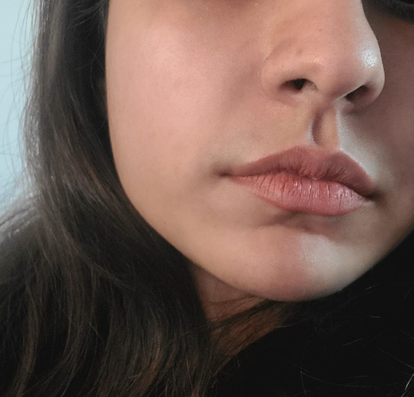 Customer photo review of ACNE CLARIFYING SERUM - Energetic Skin Therapy for Acne & Scars