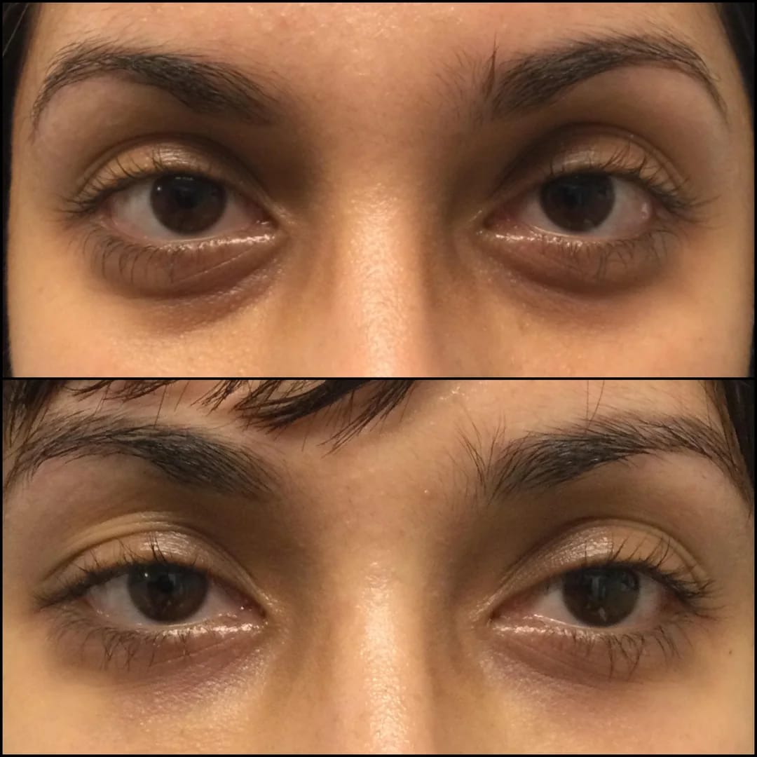Customer photo review of Under Eye Anti-Aging Wand