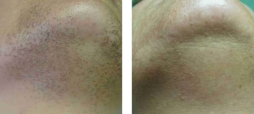 Customer photo review of No-Shave Hair Removal Spray