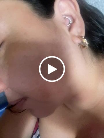 Customer video review of The Acne Set