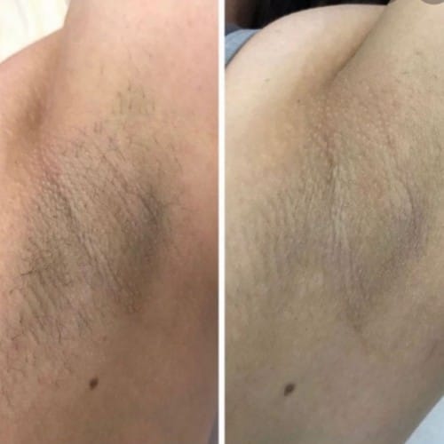 Customer photo review of No-Shave Hair Removal Spray