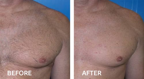 Customer photo review of No-Shave Hair Removal Spray