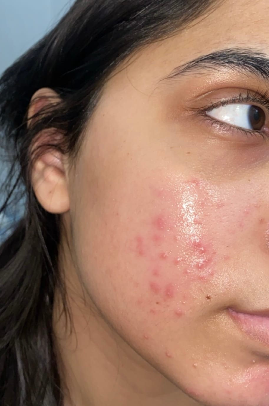 Customer photo review of ACNE CLARIFYING SERUM - Energetic Skin Therapy for Acne & Scars