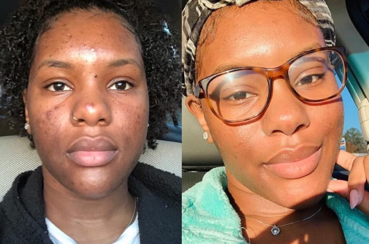 Customer photo review of 24k Golden Glow Essential Acne Kit