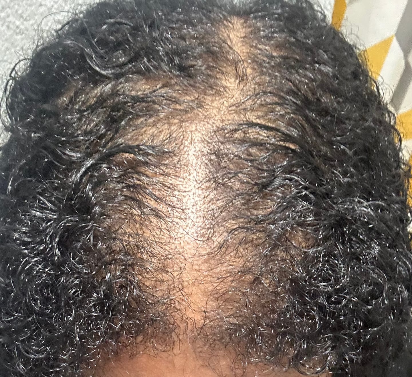 Customer photo review of Hair Growth / Thickening Oil