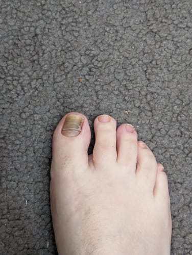 Customer photo review of Onychom - Antifungal Laser Device