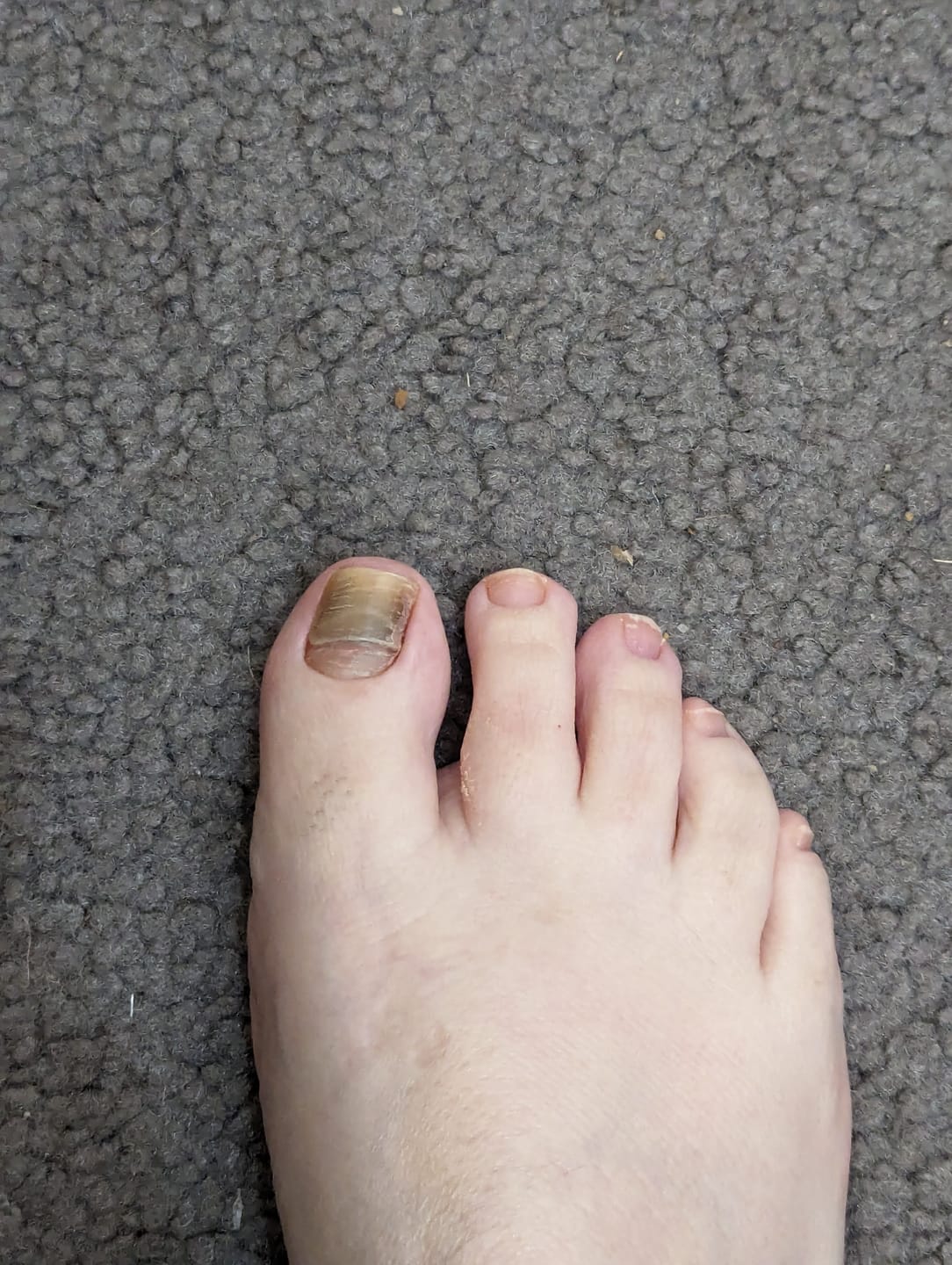 Customer photo review of Onychom Pro Antifungal LED Device