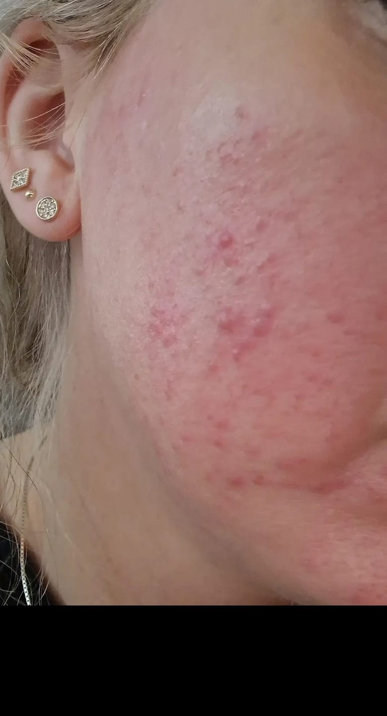 Customer photo review of Kollagen 10 000 Ren Peptide®