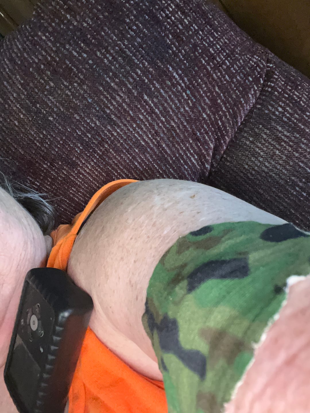 Customer photo review of Skin Grip Original - Medtronic Guardian/Enlite Adhesive Patches