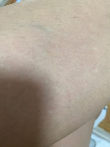 Customer photo review of Iluumi IPL Hair Removal Handset