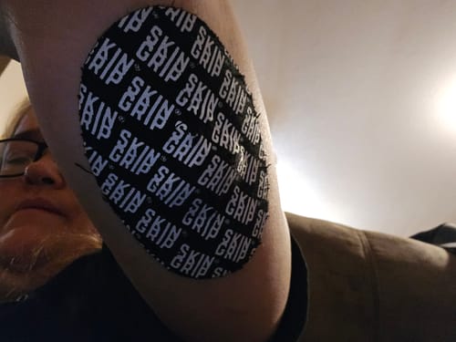 Customer photo review of Skin Grip Original - Medtronic Guardian/Enlite Adhesive Patches - 20 Pack