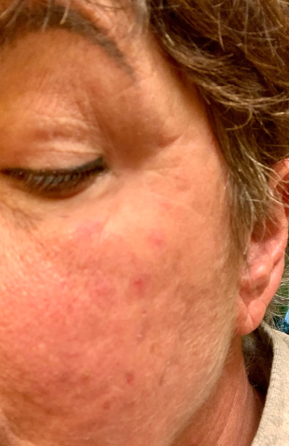 Customer photo review of Renewal Spa Mask for Scars & discolouration