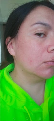 Customer photo review of LOVESKIN Acne/ Combination Skincare Ritual