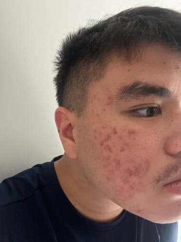 Customer photo review of Advanced Acne Program™