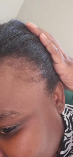 Customer photo review of Hairline Fortifying Serum 30ml