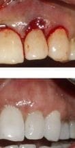 Customer photo review of 🔥Last Day - Save up to 80%!-NESLEMY™ Gum Shield Therapy Gel