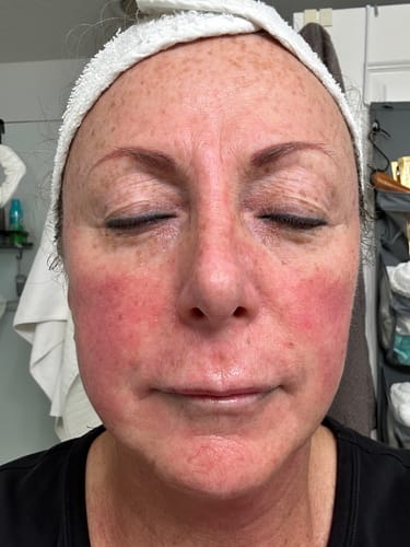 Customer photo review of Deep Pore Cleanser Normal/Combination Skin