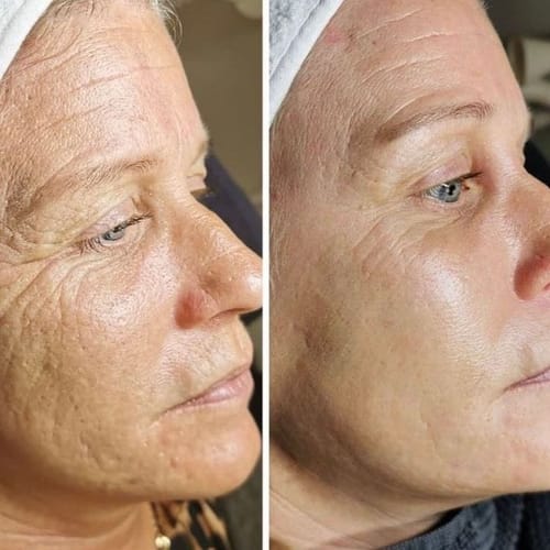 Customer photo review of Appareil EMS - Rajeunissement Facial et du Cou