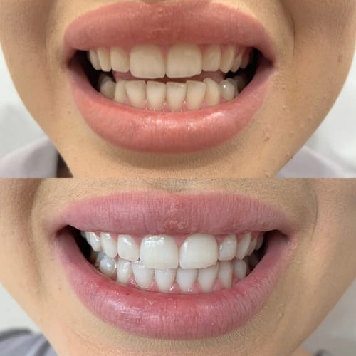 Customer photo review of משחה להלבנת שיניים - smilekit