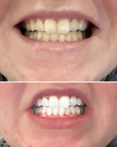 Customer photo review of משחה להלבנת שיניים - smilekit