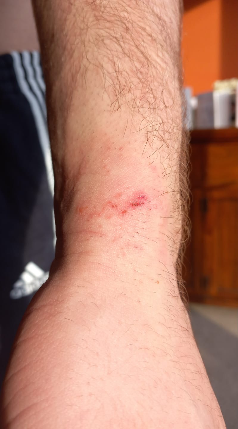 Customer photo review of Bioskin Zeoderm Skin Repair Moisturiser