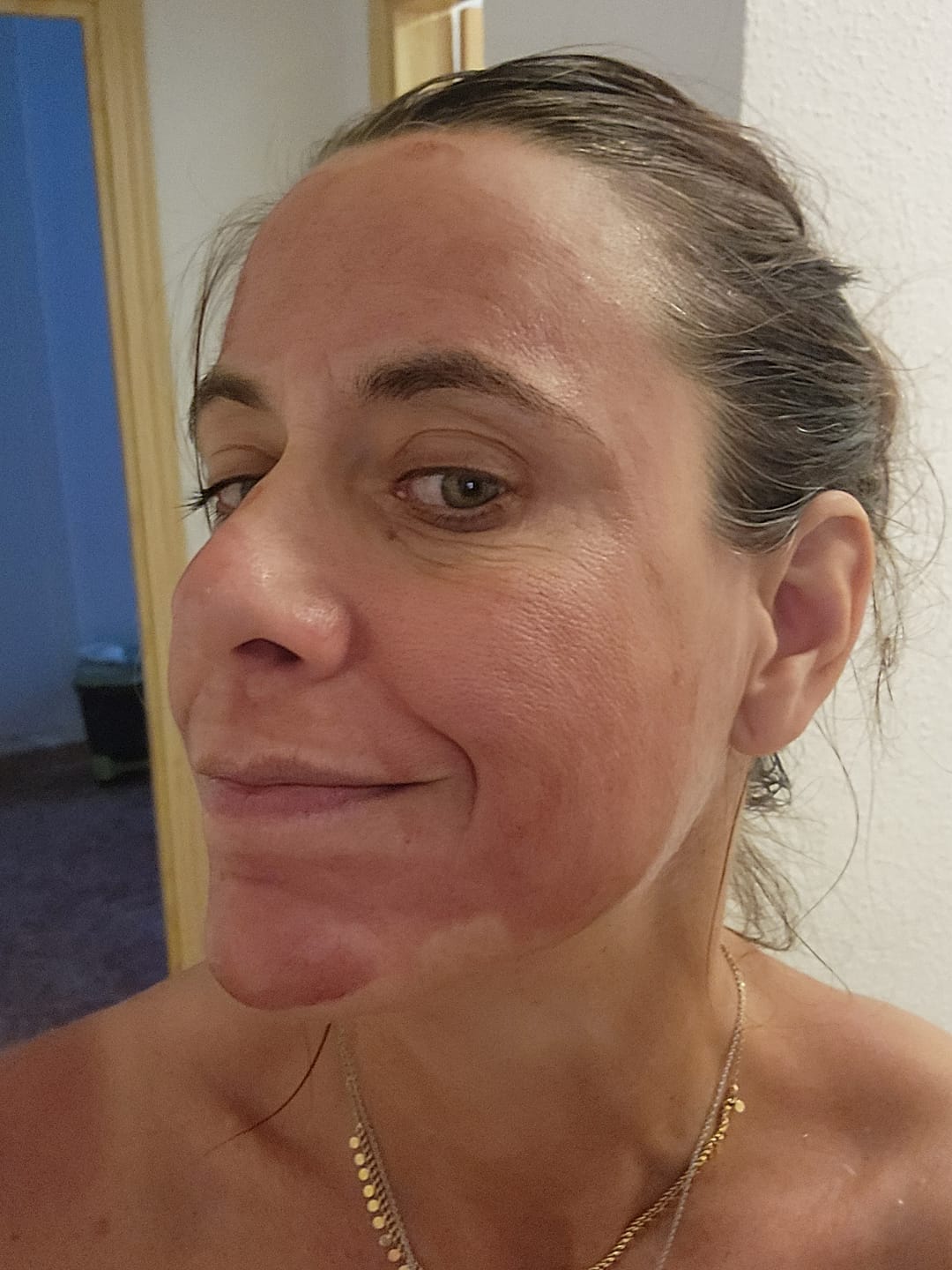 Customer photo review of VAMPIRE PEEL® - Fruchtsäurepeeling