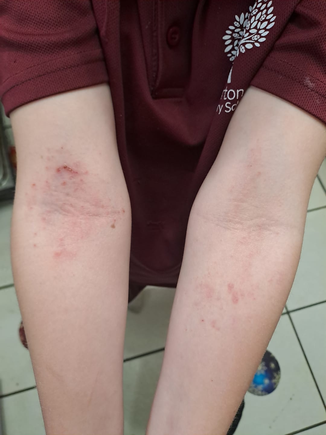 Customer photo review of Bioskin Junior Duo Pack (Free Outbreak Rescue Cream)