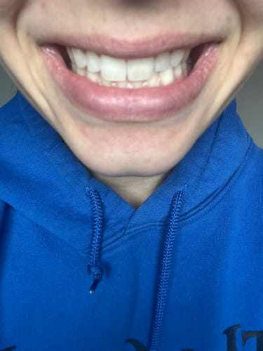 Customer photo review of Prostrips Teeth Whitening Strips