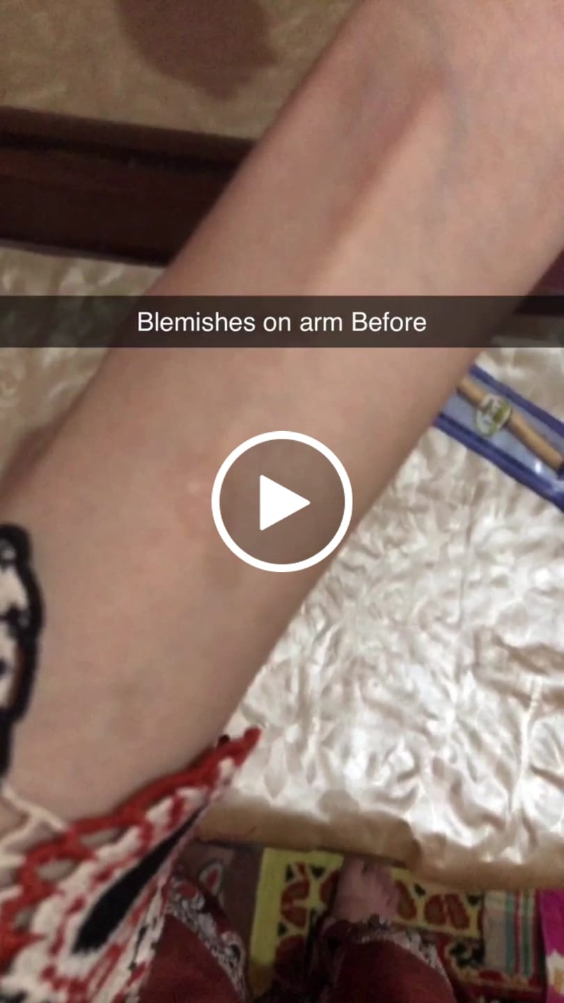 Customer video review of Freckles Fade Serum – Hydrates Skin, Fade Freckles, Reduce Blemishes & Lighten Pigmentation