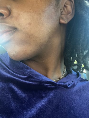 Customer photo review of BERRI-CLEAR+ 5 BERRY SUPERFRUIT SERUM