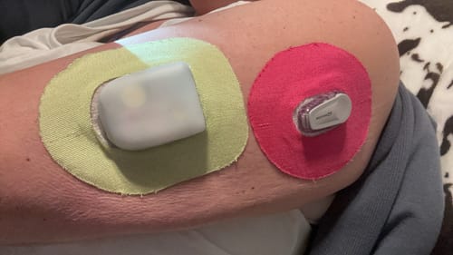 Customer photo review of Skin Grip Original - Dexcom G6 Patches - 20 Pack