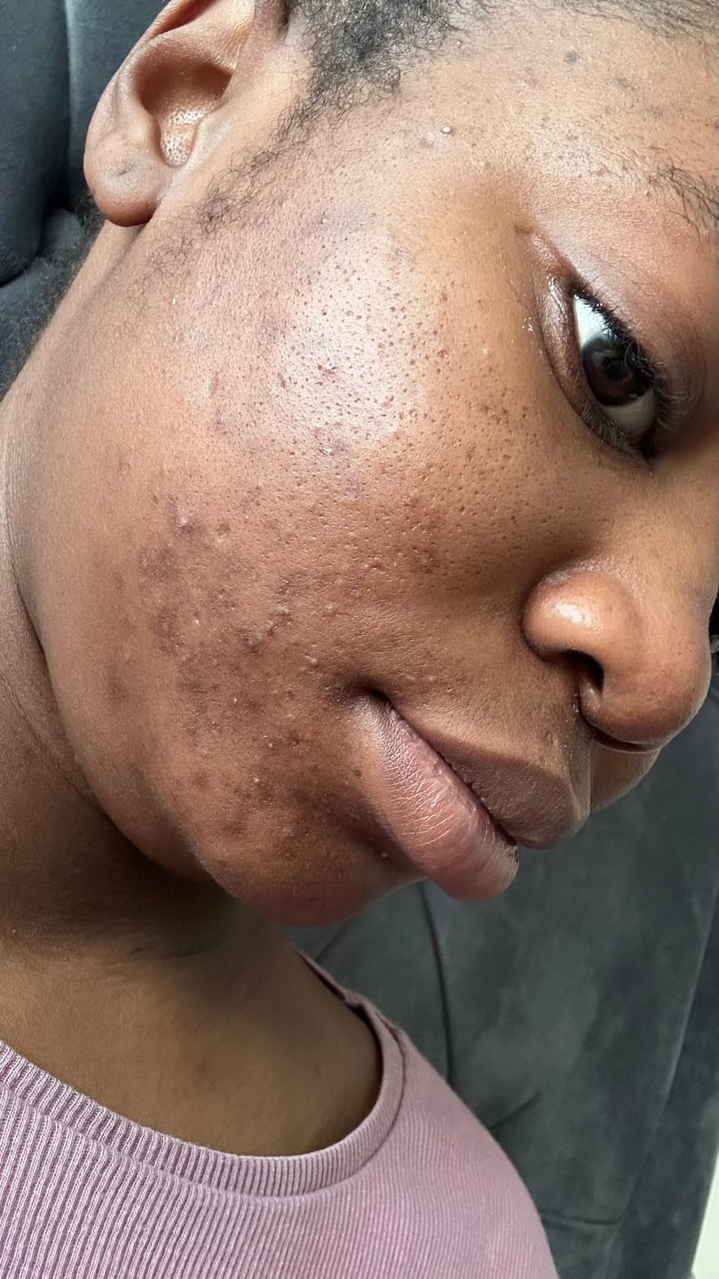 Customer photo review of Glow Bundle -Salicylic Acid + Sulphur Facial Cleanser & Body Soap