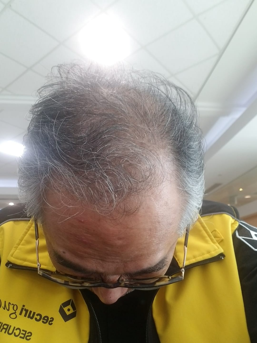 Customer photo review of Revivv For Him 3 Month Hair Rejuvenation Serum