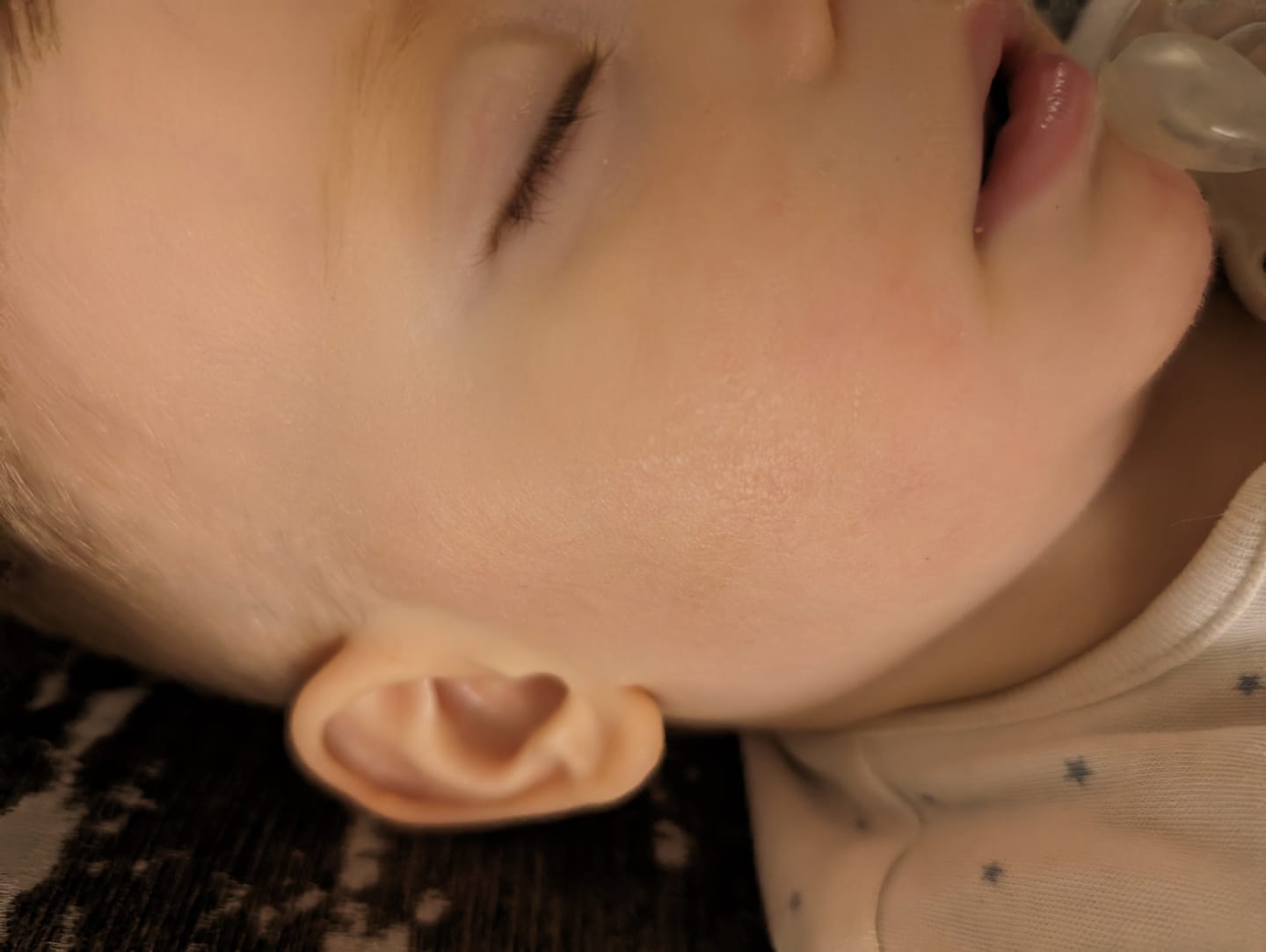 Customer photo review of Bioskin Junior Duo Pack (Free Outbreak Rescue Cream)