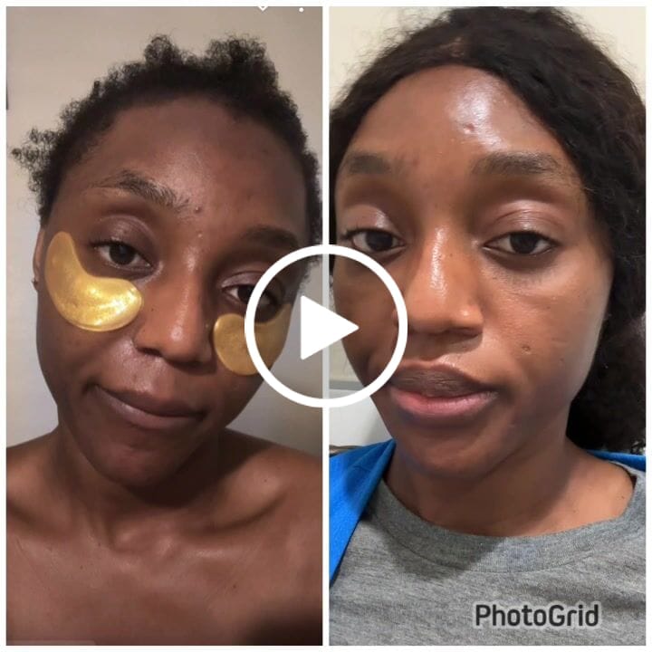 Customer video review of 24k Golden Glow Essential Acne Kit