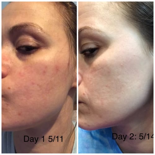 Customer photo review of BeautyPro™️ 2.0 - 4 in 1 High Frequency Wand