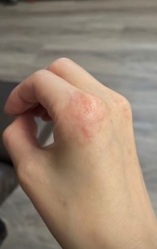 Customer photo review of B-Restore™ Barrier Cream