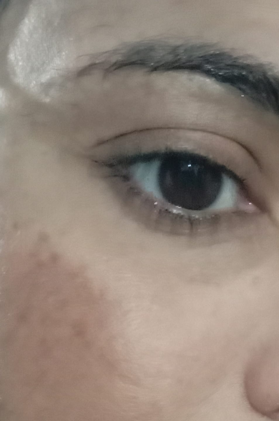 Customer photo review of SPECIAL PIGMENTATION BUNDLE (MELASMA, FRECKLES & DARK SPOTS)